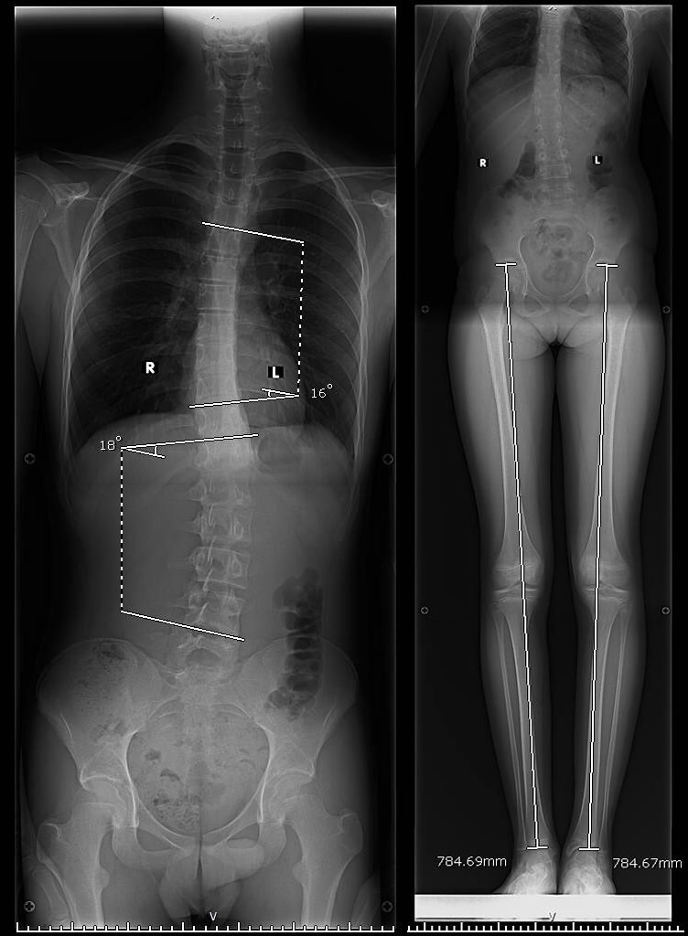 radiografie umar pret picioarele sunt grele  iar picioarele în articulație doare